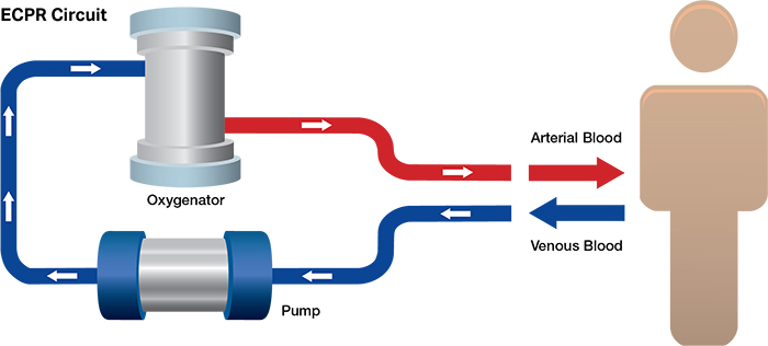 Figure 8. Schematic depiction of components of extracorporeal membrane oxygenator circuit as used for ECPR.