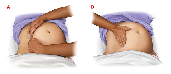 Manual left uterine displacement illustration Figure 16. A, Manual left lateral uterine displacement, performed with 2-handed technique. B, 1-handed technique during resuscitation.