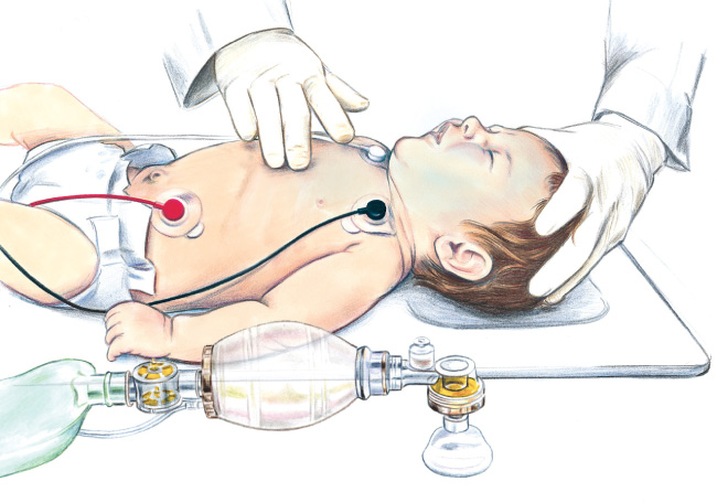 2-finger compressions on infant illustration 2-finger compressions on infant illustration