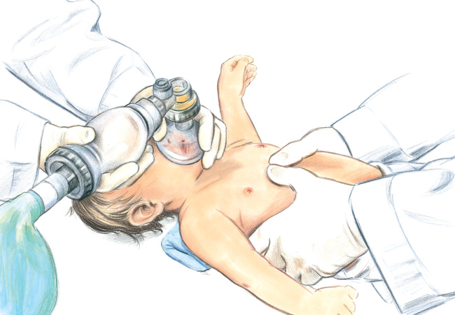 2-thumb encircling hands compressions on infant illustration 2-thumb encircling hands compressions on infant illustration