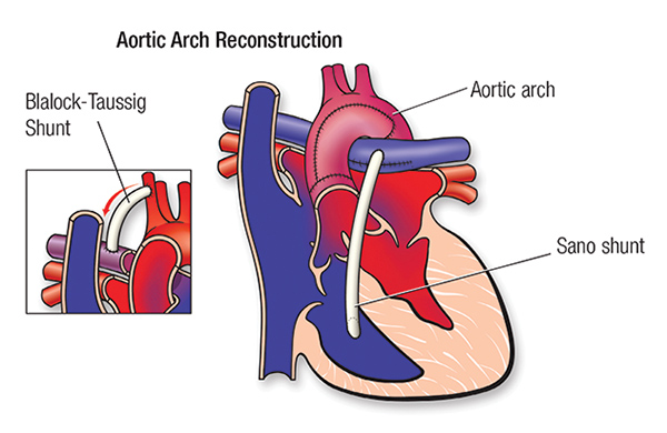 50-1683-61 HLHS Repair Aortic Arch illustration 50-1683 61 HLHS Repair Aortic Arch illustration