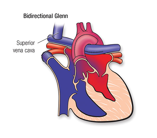 50-1683-62a HLHS Repair Bidirectional Glenn illustration 50-1683-62a HLHS Repair Bidirectional Glenn illustration