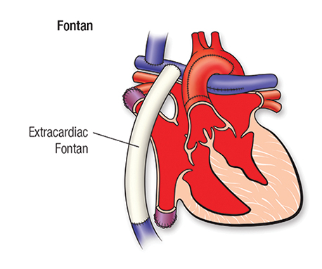 50-1683-62b HLHS Repair Fontan illustration 50-1683-62b HLHS Repair Fontan illustration